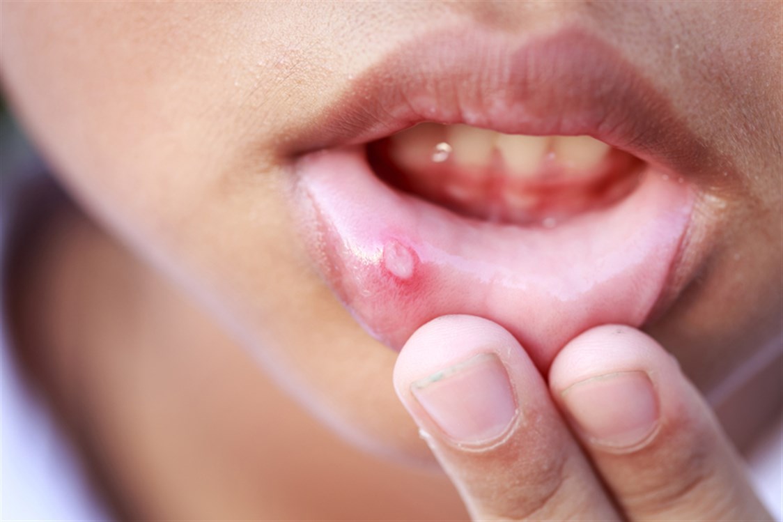 علامة تظهر داخل الفم تشير إلى الإصابة بجدري القرود