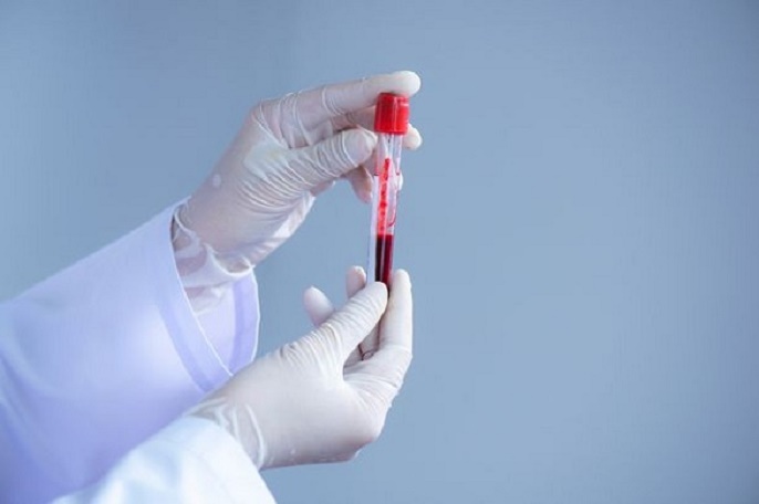 عينة دم بعد بداية العلاج الكيميائي تكشف مستقبل مرضى السرطان