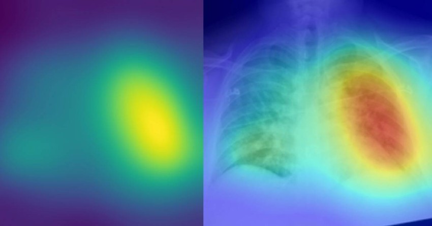 الذكاء الاصطناعي يشخص الإصابة بكورونا من خلال الأشعة السينية